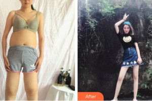 桂林時光整形美容醫(yī)院毛建文整形價格表附大腿吸脂案例展示