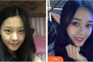 太原星范醫(yī)療美容門診部嚴(yán)健頻整形價格表附埋線提升案例展示