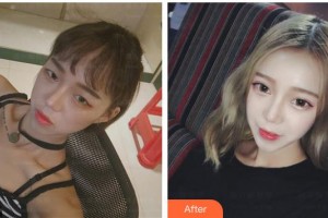 太原華美整形美容醫(yī)院趙亞峰整形價格表附切開雙眼皮案例展示