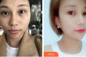 太原麗都整形美容醫(yī)院王同坡整形價格表附埋線提升案例展示