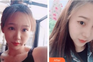 太原愛爾眼科醫(yī)院陳文娟整形價格表附鼻部綜合案例展示