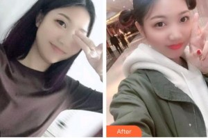太原恒倫口腔醫(yī)院馬國華整形價格表附根管調(diào)節(jié)案例展示
