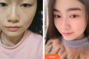 太原星范醫(yī)療美容門診部蘭秀琴整形價格表附眼部修復(fù)案例展示