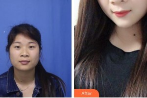 大同美神整形美容醫(yī)院賈文整形價格表附光子嫩膚案例展示