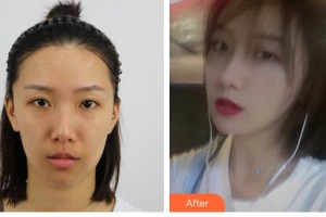 大同鳳凰婦產(chǎn)醫(yī)院整形美容科王艷波整形價格表附耳軟骨復(fù)合隆鼻案例展示