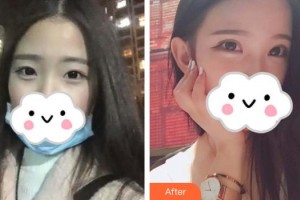 長(zhǎng)治亮麗保健醫(yī)學(xué)美容診所王佳琦整形價(jià)格表附眼部綜合案例展示