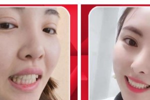 長(zhǎng)治同康眼科醫(yī)院鄭東萍整形價(jià)格表附貴金屬烤瓷牙案例展示
