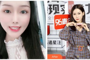 長(zhǎng)治億大口腔醫(yī)院李維文整形價(jià)格表附金屬托槽矯正案例展示