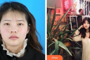 長治天成醫(yī)療美容診所董琪整形價格表附眼部綜合案例展示