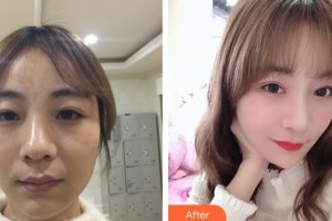 晉城鳳凰整形美容醫(yī)院李圣吉整形價格表附切開雙眼皮案例展示