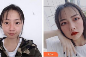 晉中鷹華眼科醫(yī)院石一寧整形價格表附激光去眼袋案例展示