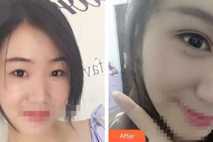 晉中鷹華眼科醫(yī)院陳有信整形價格表附眼部綜合案例展示