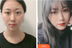 運城市中心醫(yī)院整形外科程銀忠整形價格表附激光祛斑案例展示