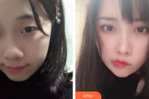 運城愛爾眼科醫(yī)院莊立整形價格表附切開雙眼皮案例展示
