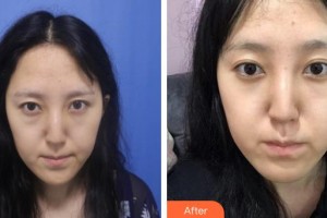 運城市眼科醫(yī)院許衛(wèi)玲整形價格表附切開雙眼皮案例展示