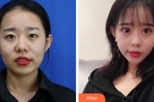 西寧欣怡醫(yī)學整形美容門診部王善冬整形價格表附雙眼皮手術案例展示