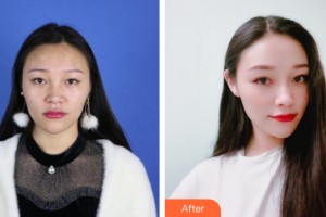 西寧時光整形醫(yī)院薛政整形價格表附鼻部手術案例展示