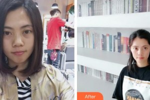 內(nèi)蒙古佳麗醫(yī)療美容診所張振林整形價格表附光子嫩膚案例展示