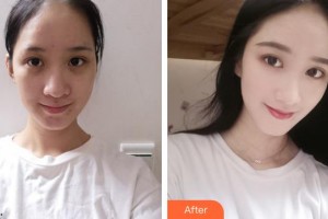 呼和浩特伊思整形?？漆t(yī)院白莉整形價格表附紅藍光祛痘案例展示