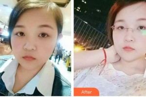 呼和浩特五洲女子醫(yī)院整形美容中心王煥整形價(jià)格表附激光祛斑案例展示