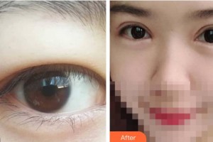 呼和浩特維科美容整形診所辛來(lái)整形價(jià)格表附切開(kāi)雙眼皮案例展示