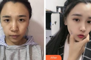 呼和浩特京美醫(yī)療形美容醫(yī)院郝維亮整形價(jià)格表附眼部綜合案例展示
