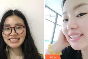 呼和浩特董志新口腔門診部賽吉亞整形價(jià)格表附金屬托槽矯正案例展示