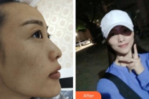 包頭聯(lián)合麗格醫(yī)療美容門診部崔曉穎整形價(jià)格表附激光祛斑案例展示