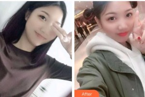 包頭貝特瑞爾口腔門(mén)診部王鳳英整形價(jià)格表附根管調(diào)節(jié)案例展示