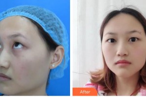 赤峰朝聚眼科醫(yī)院翟長斌整形價(jià)格表附切開雙眼皮案例展示