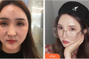 長春奧拉克美容醫(yī)院陳繼革整形價格表附手術縮鼻頭案例展示