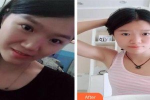 長(zhǎng)春美奇醫(yī)療美容外科門(mén)診部張鵬飛整形價(jià)格表附埋線提升案例展示
