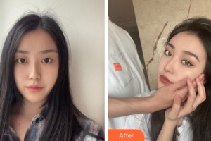 新疆張瑞紅醫(yī)療美容診所張瑞紅整形價(jià)格表附眼部手術(shù)案例展示