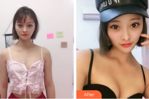 新疆威茲曼整形外科醫(yī)院王曉建整形價(jià)格表附隆胸手術(shù)案例展示