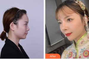 烏魯木齊黎美整形門診部穆生海整形價(jià)格表附鼻部手術(shù)案例展示