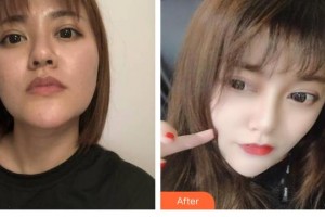 陜西華西醫(yī)院西美整形美容中心李明升整形價(jià)格表附埋線(xiàn)提升案例展示