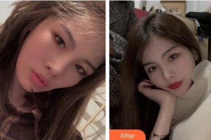 陜西華西醫(yī)院西美整形美容中心何旭整形價(jià)格表附眼部綜合案例展示