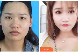 寶雞愛爾眼科醫(yī)院李康寯整形價(jià)格表附切開雙眼皮案例展示