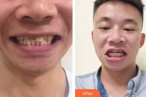 寶雞市口腔醫(yī)院馮耀浦整形價(jià)格表附牙齒隱形矯正案例展示