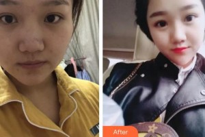 貴州省紅十字會(huì)婦女兒童醫(yī)院整形美容中心謝詩思整形價(jià)格表附紅藍(lán)光祛痘案例展示