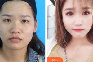 貴州整形美容外科醫(yī)院席小紅整形價格表附切開雙眼皮案例展示