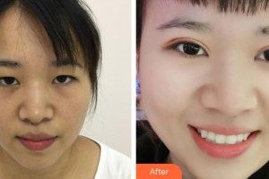 貴陽愛爾眼科醫(yī)院陳國榮整形價格表附定點(diǎn)雙眼皮案例展示