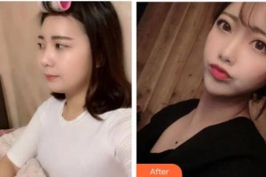 貴陽愛爾眼科醫(yī)院蒲麗整形價格表附眼部綜合案例展示