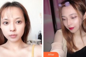 六盤水吳氏嘉美醫(yī)療美容門診部楊遠(yuǎn)平整形價格表附微針美膚案例展示