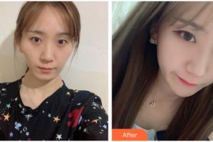 遵義韓美整形美容醫(yī)院安基云整形價(jià)格表附顴骨顴弓整形術(shù)案例展示