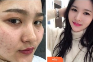 遵義喬雅菲醫(yī)療美容門診部羅碧強(qiáng)整形價格表附紅藍(lán)光祛痘案例展示