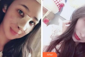青?？等A整形醫(yī)院馬晶整形價(jià)格表附鼻部綜合案例展示