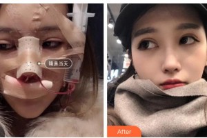 青?？等A整形醫(yī)院蔡志昆整形價(jià)格表附鼻部綜合案例展示