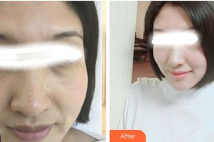張家港康麗?？漆t(yī)院整形美容外科陸玉萍整形價(jià)格表附美白嫩膚案例展示