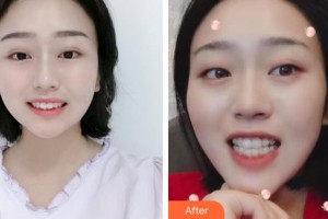 張家港康麗?？漆t(yī)院整形美容外科劉勝整形價(jià)格表附牙齒隱形矯正案例展示